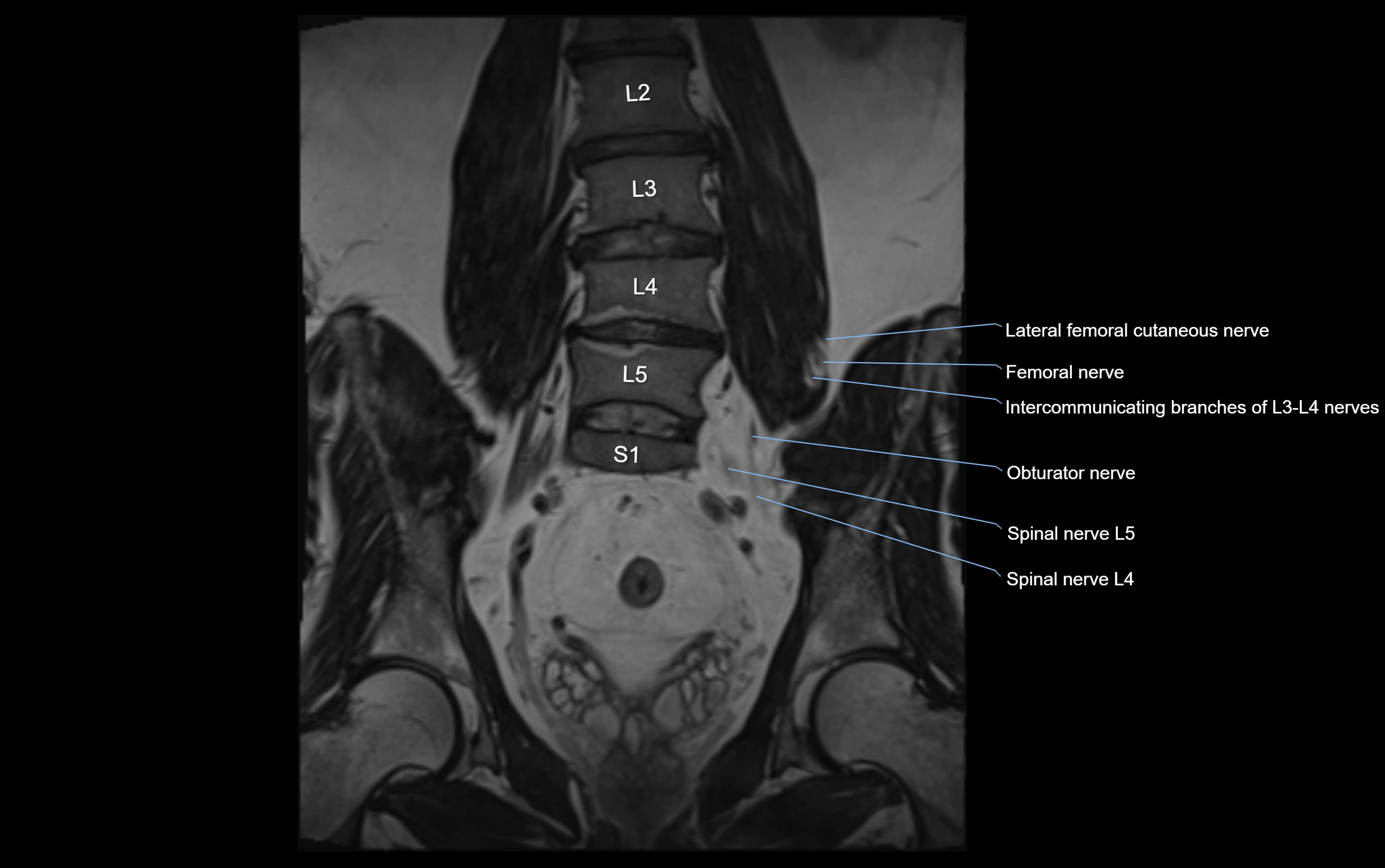 MR lumbosacral plexus cross sectional anatomy 3T  radiology  image-img-09001-00030.webp